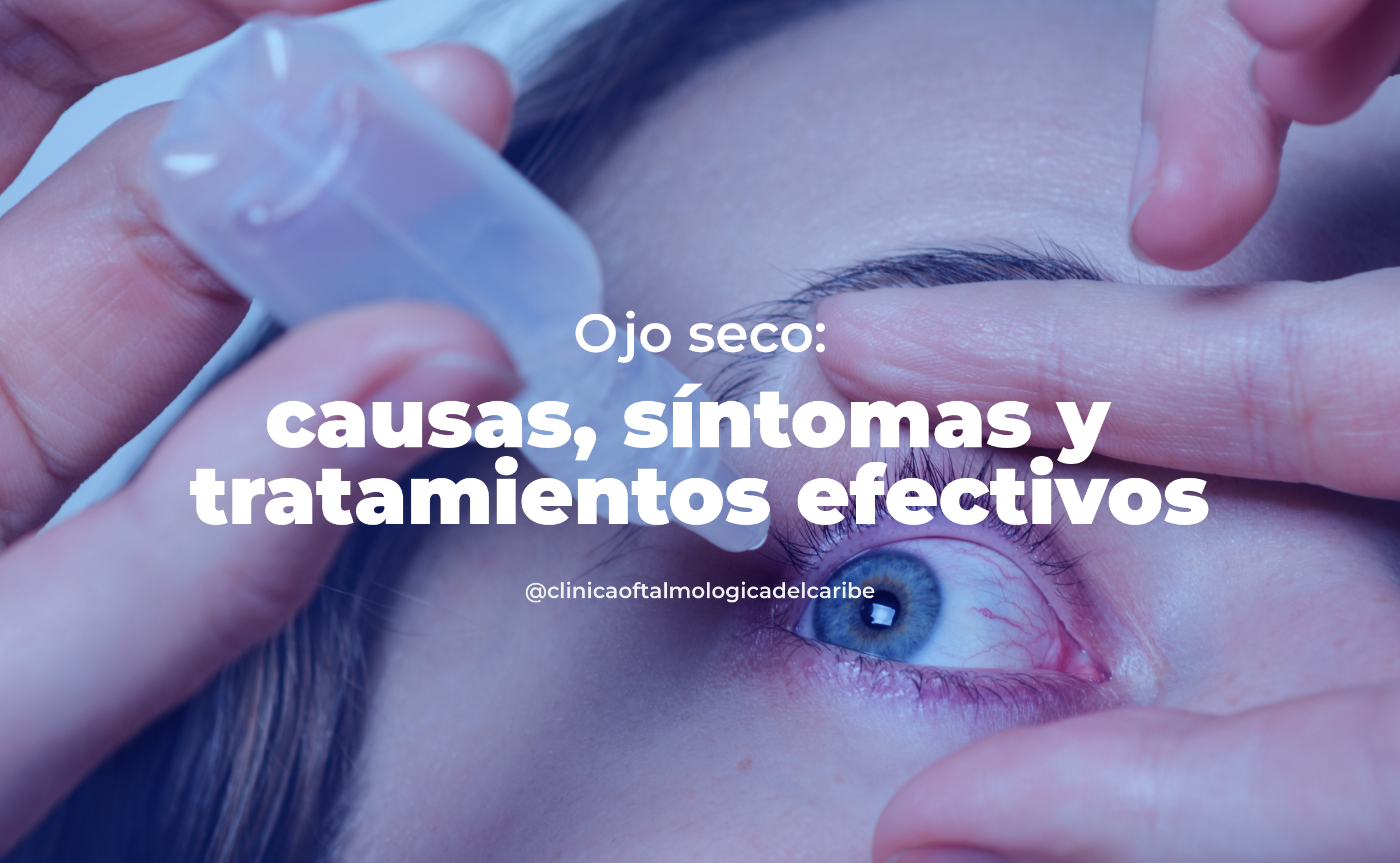 Tratamiento de ojo seco en COFCA Barranquilla: diagnóstico avanzado, lágrimas artificiales, cambios en el entorno, compresas tibias y manejo personalizado según síntomas y causas